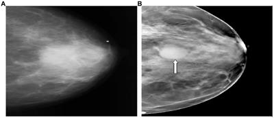 The ability of digital breast tomosynthesis to reduce additional examinations in older women